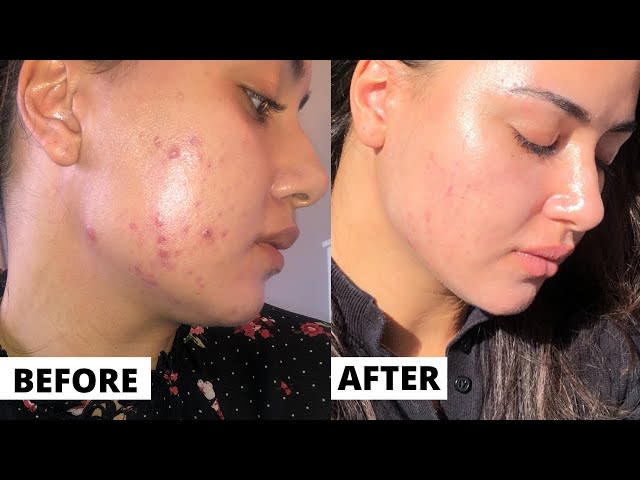 Tretinoin 3 month Update (FAITH RESTORED!! ) Tretinoin Before And After  Results | DERMATICA - YouTube