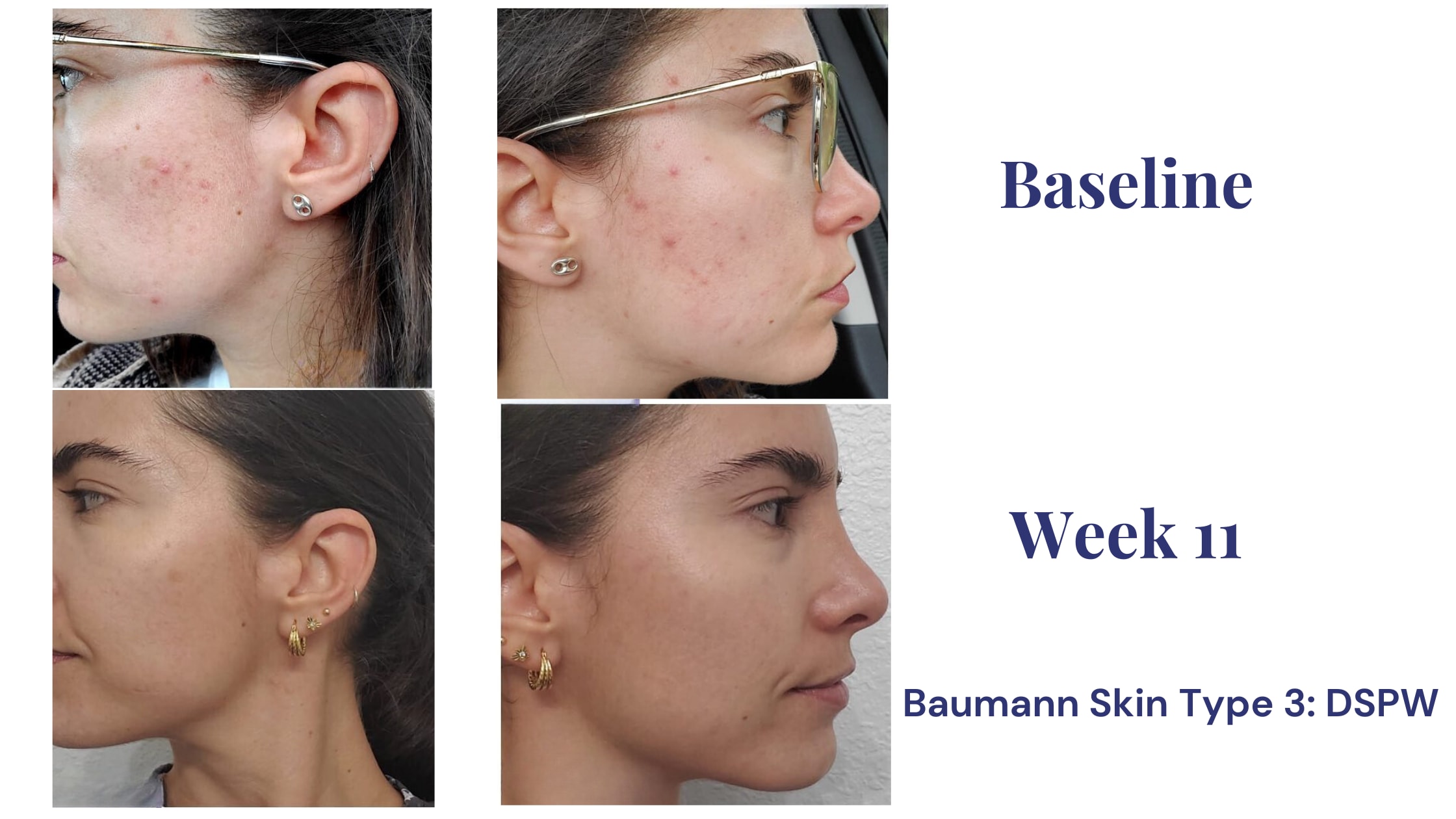 bacne before and after retinol