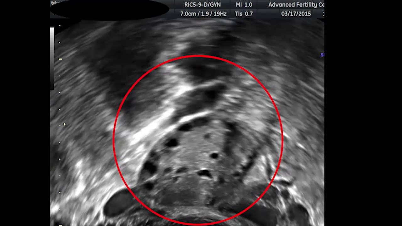 Antral Follicle Counting with Ultrasound Video