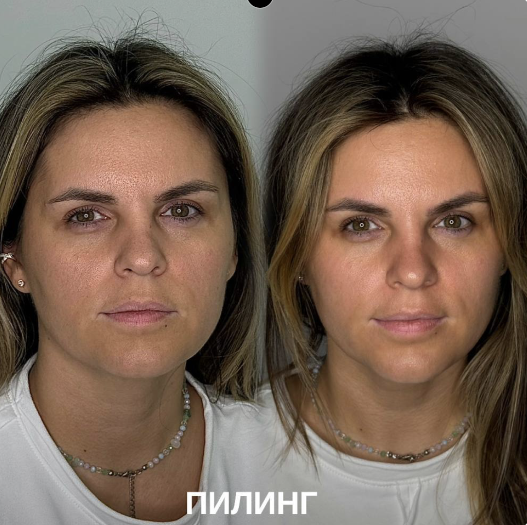 Фото до и после пилинга — 2