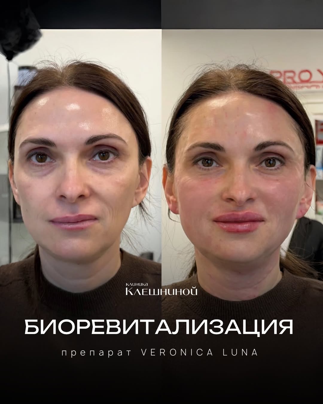 Эффект биоревитализации