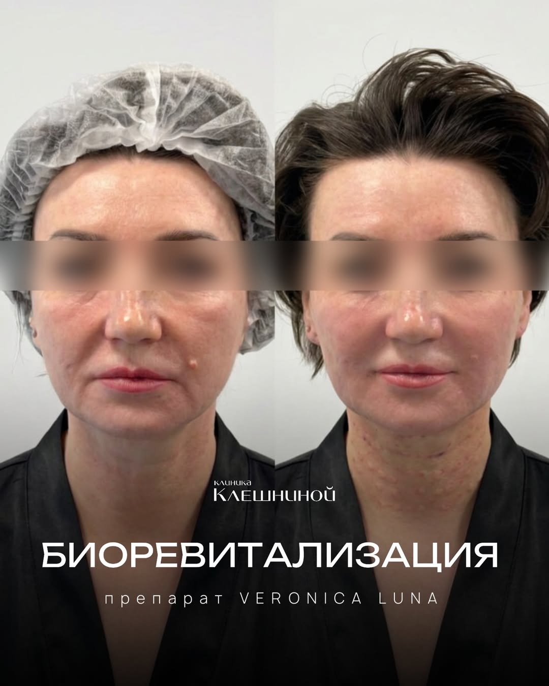 Биоревитализация до и после