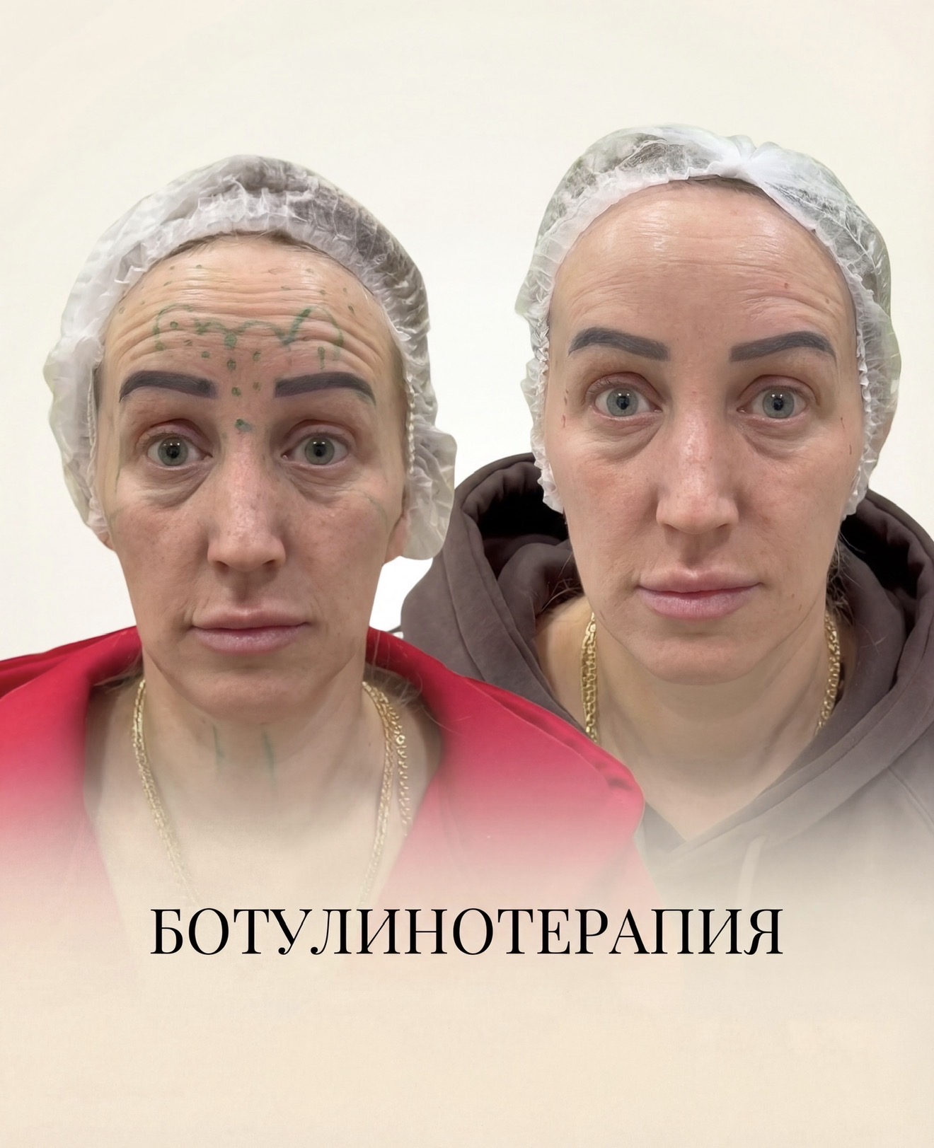 Ботулинотерапия