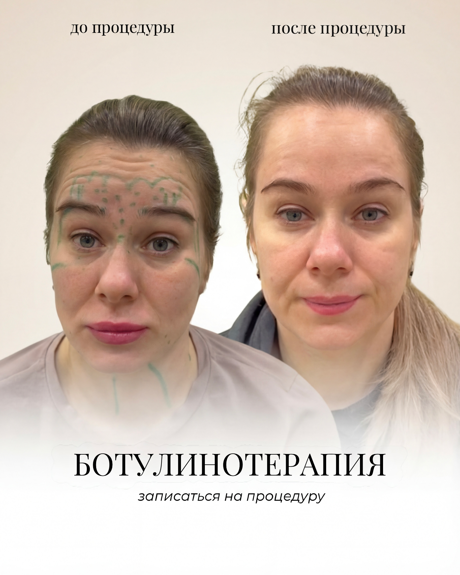 Ботокс до и после