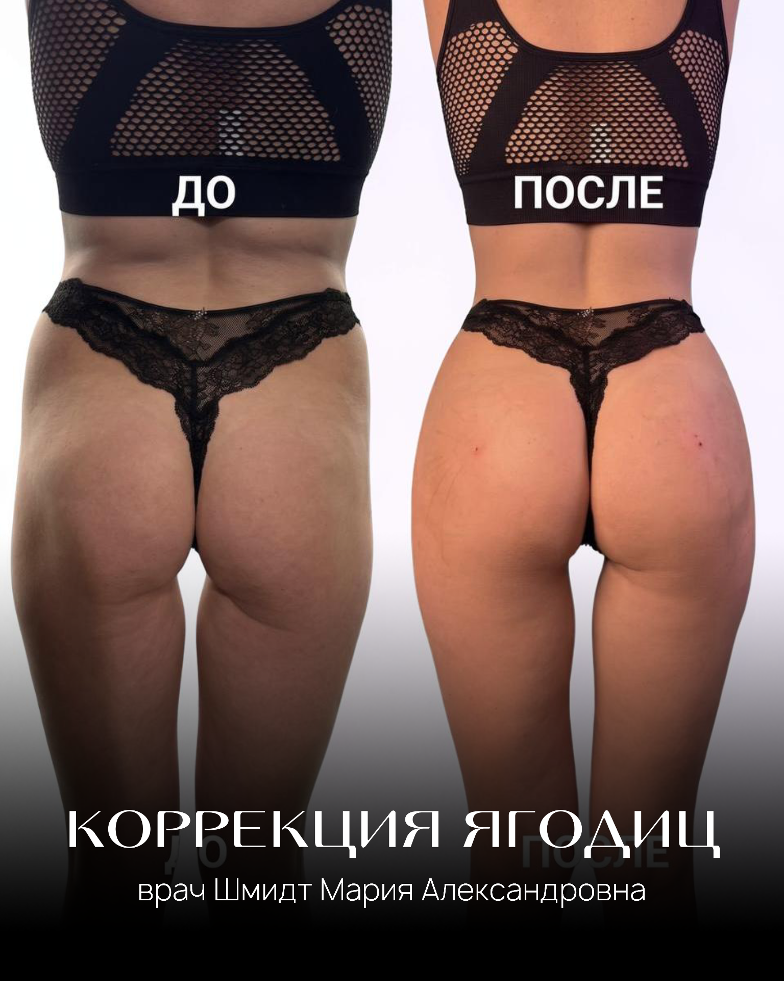 Увеличение ягодиц филлерами до и после Ставрополь