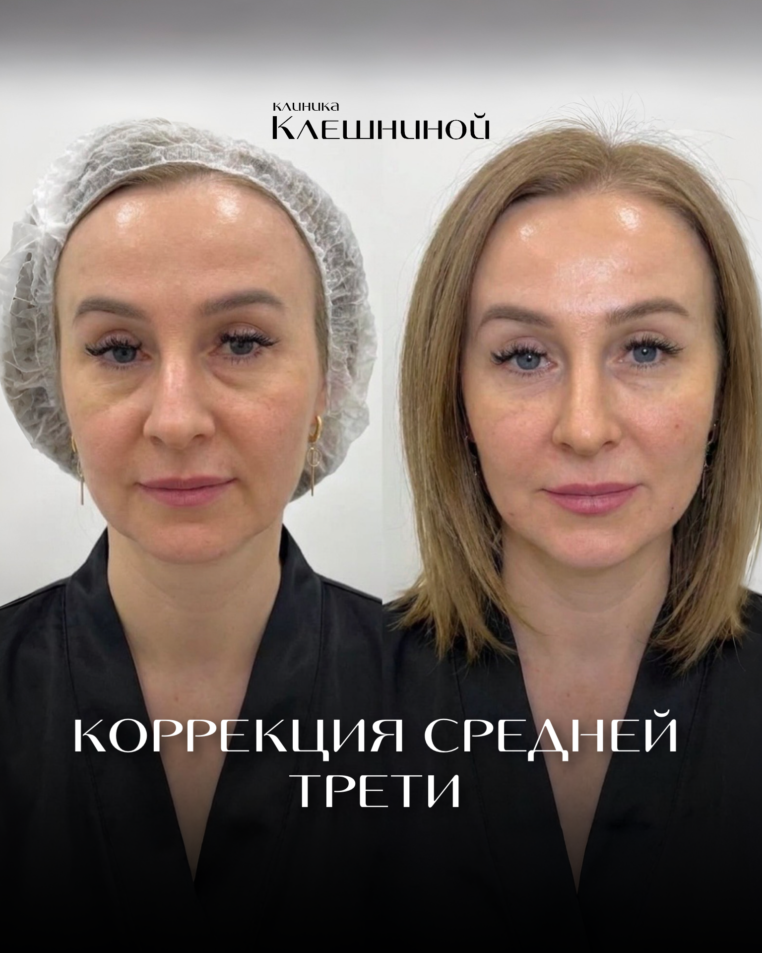 Контурная пластика скул до и после