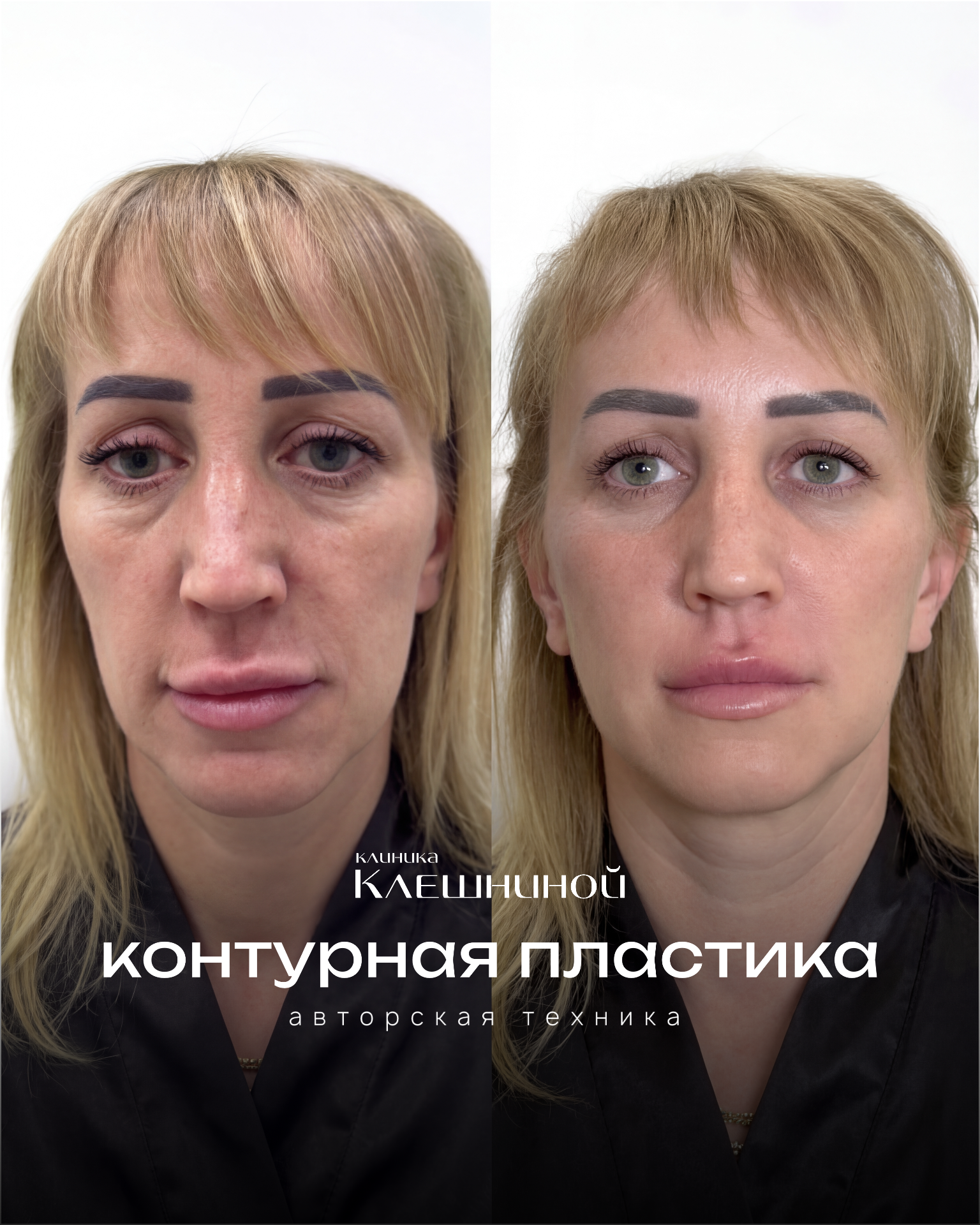 Контурная пластика губ до и после Ставрополь