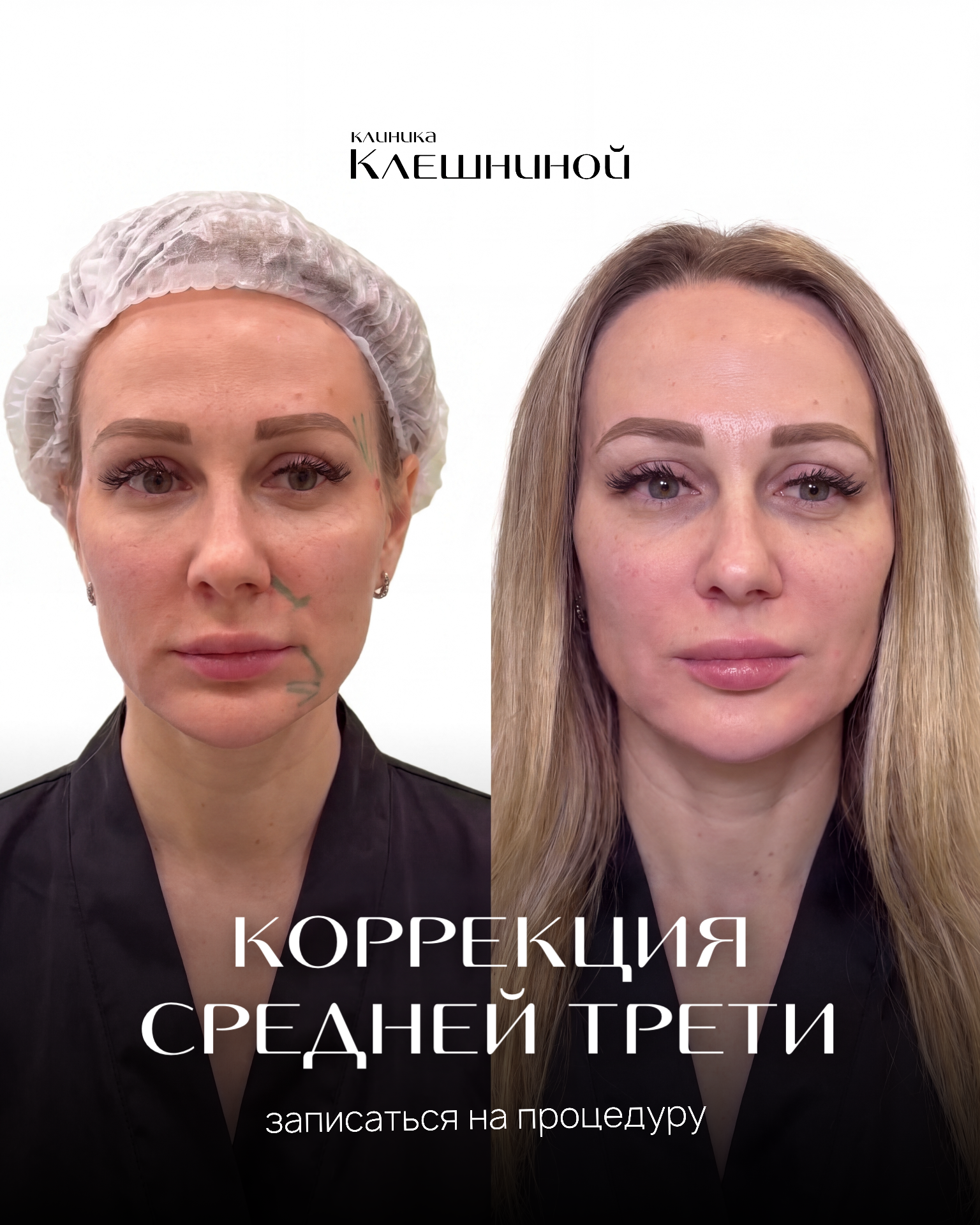 Контурная пластика лица результат