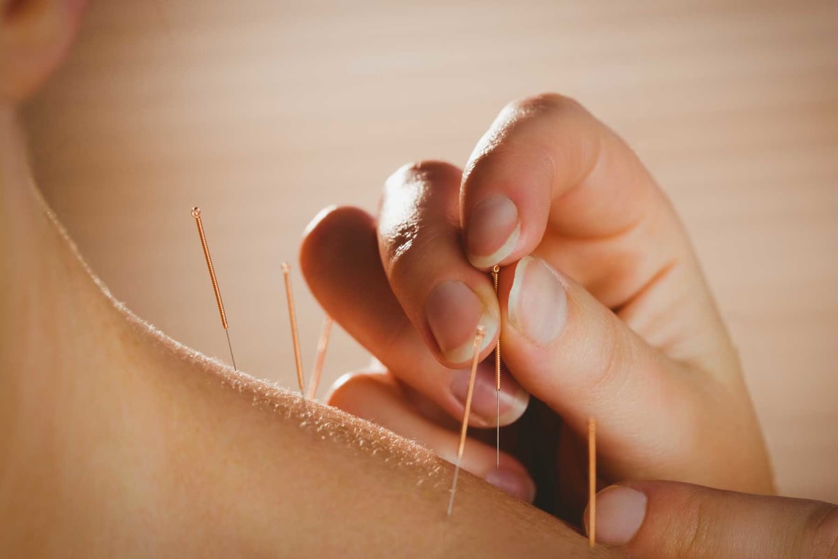 Find a acupuncturists near you