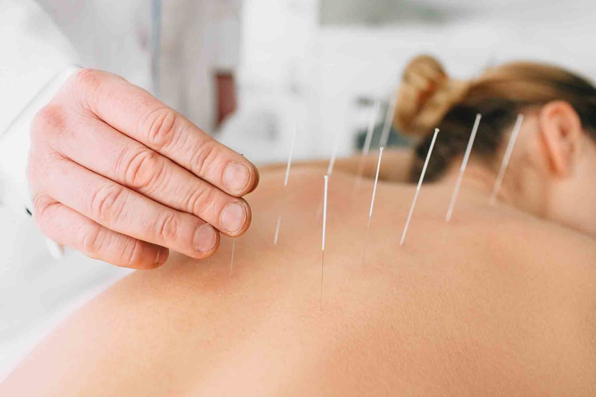 How much does acupuncture cost?