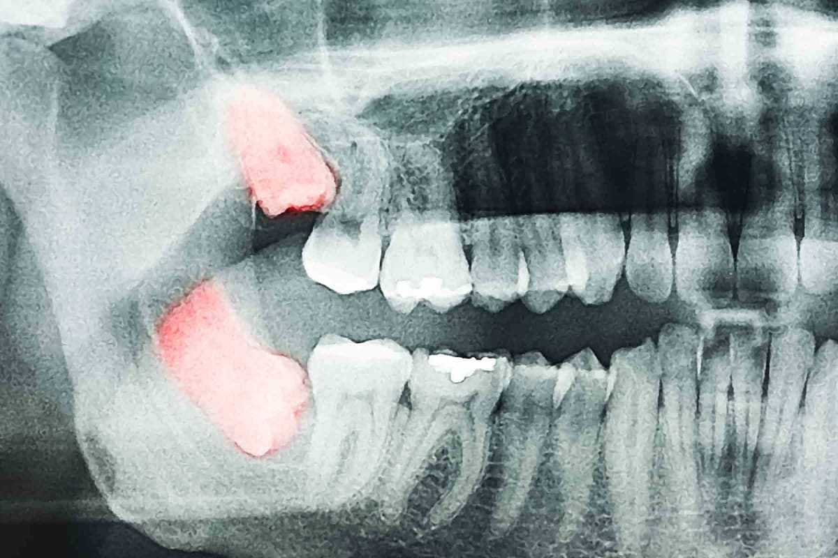 How much does wisdom teeth removal cost?