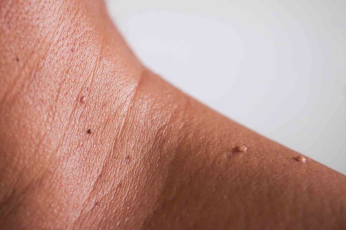 How much does skin tag removal cost?