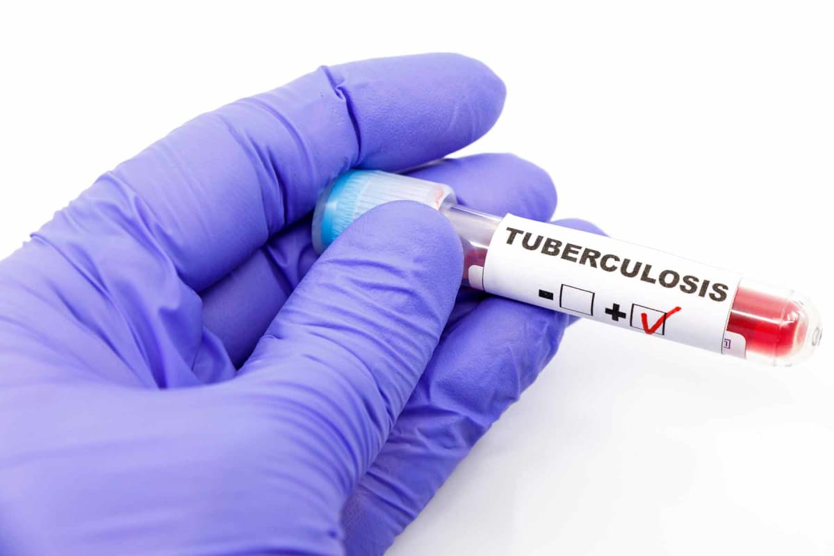 How much does a TB test cost?