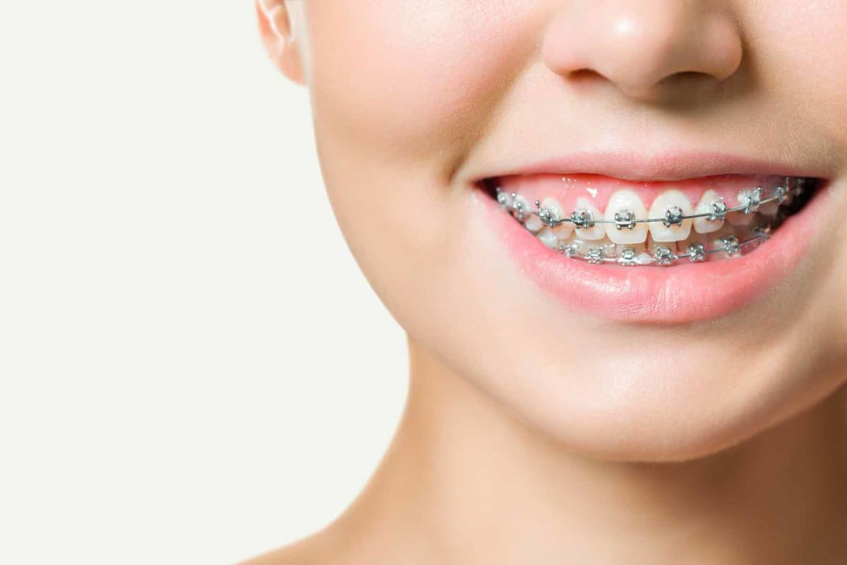 How much do braces cost?