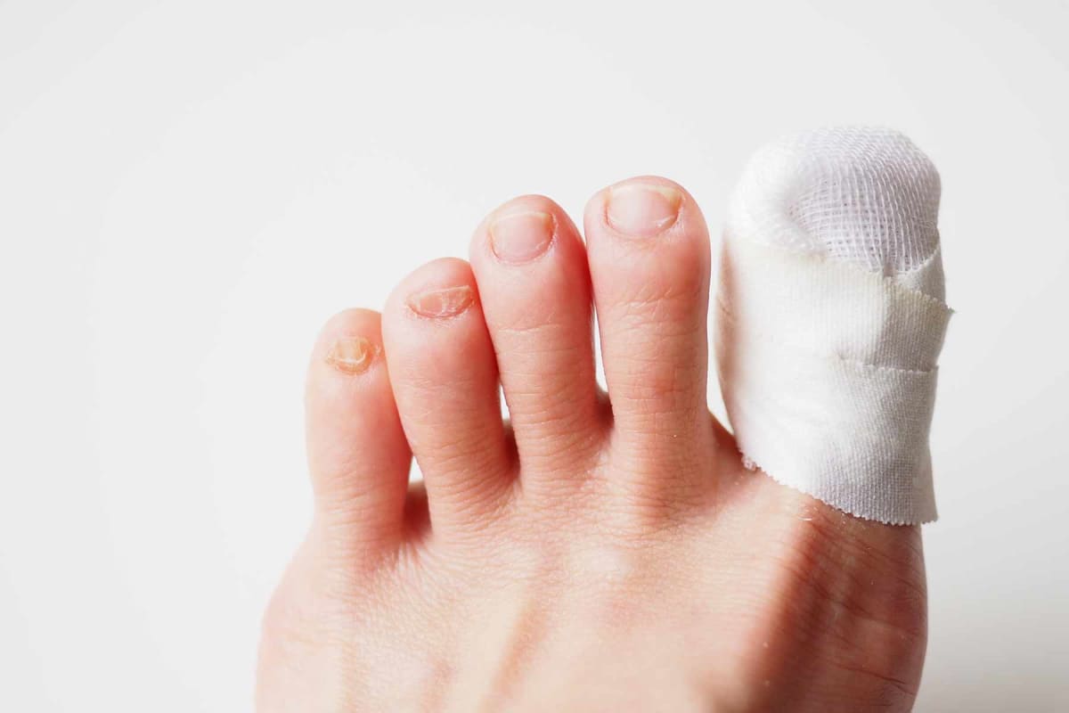 How much does ingrown toenail removal cost?