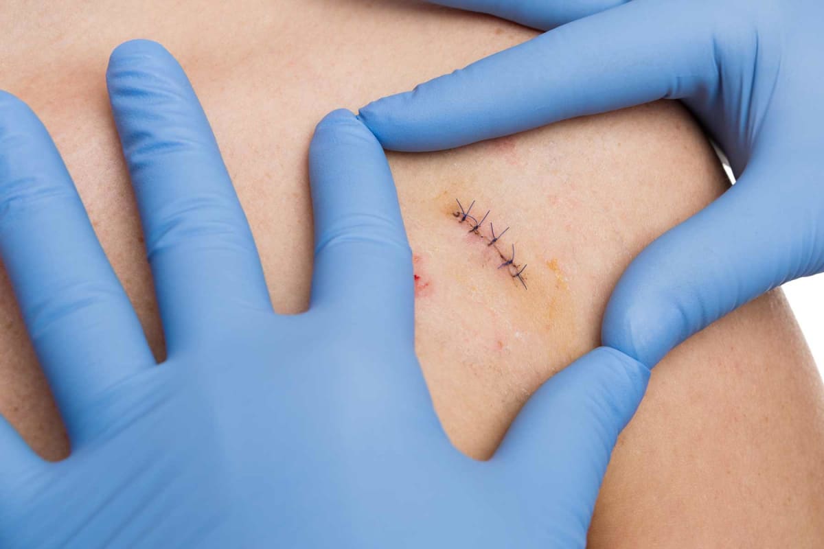 How much do stitches cost?