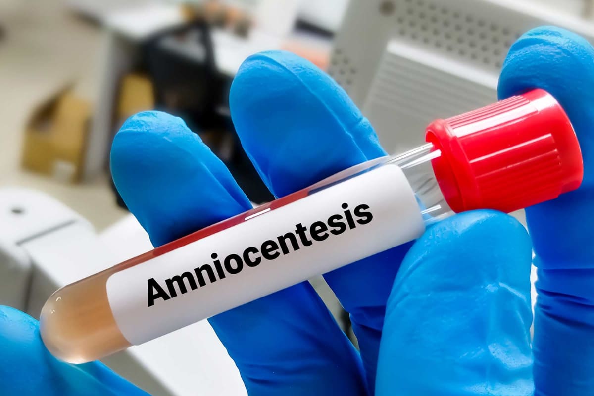 How much does an amniocentesis test cost?