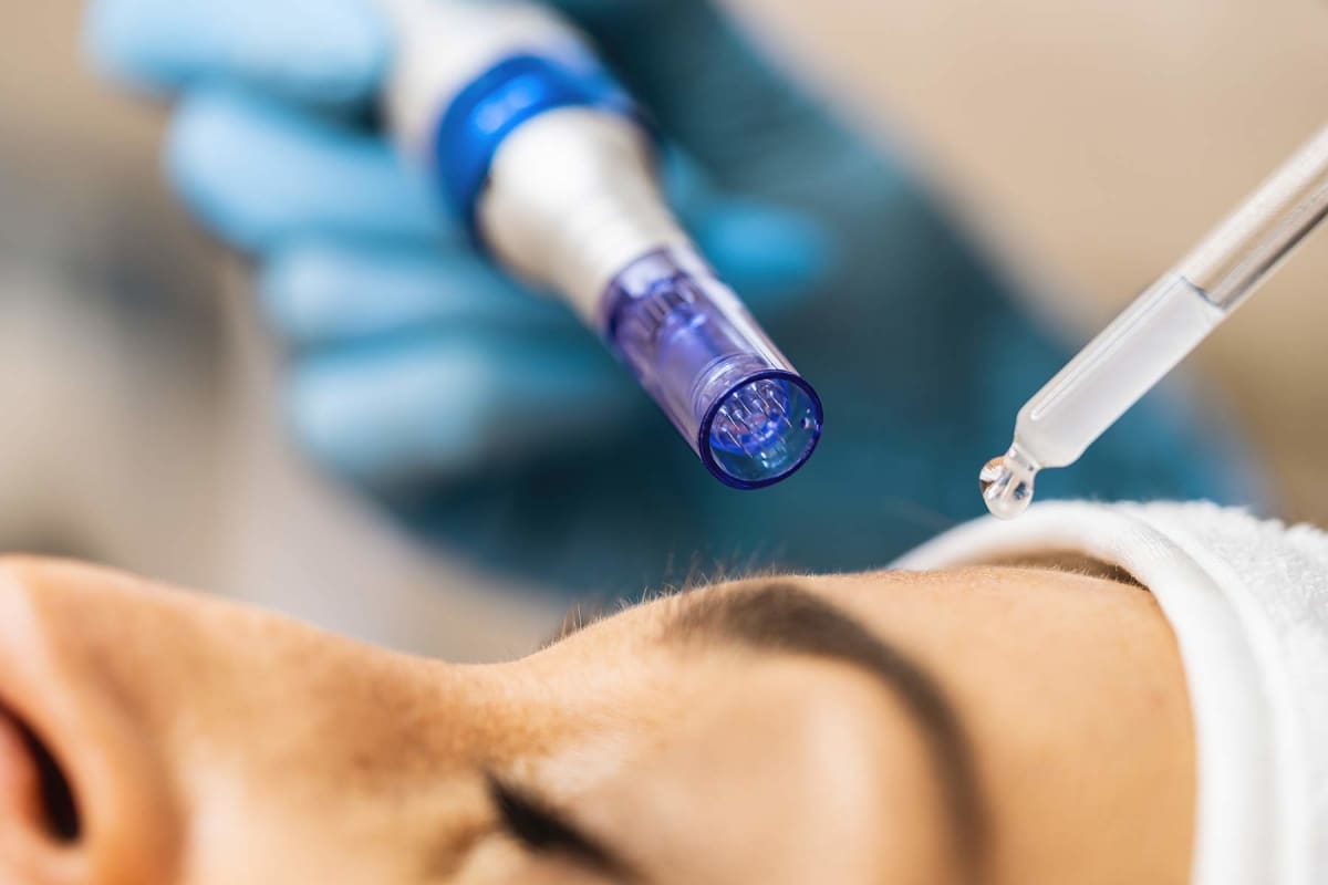 How much does PRP microneedling cost?