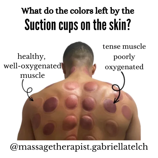 AUGUST PROMOTION, CUPPING THERAPY AND RELA