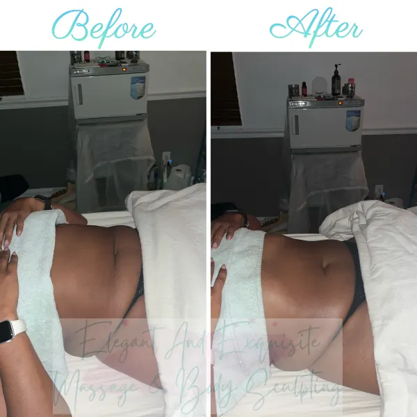  Body Sculpting Treatment