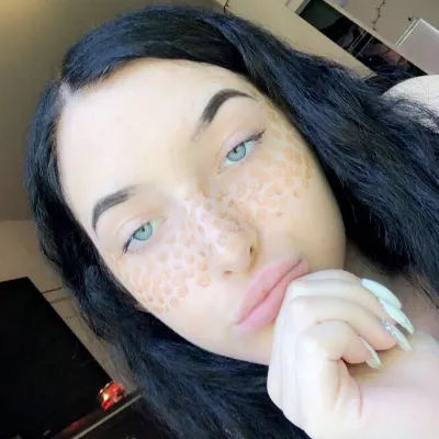 Acne Landscaping