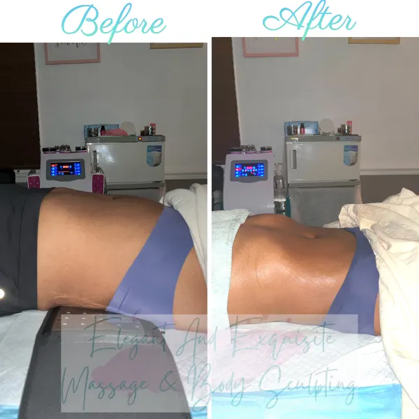  Body Sculpting Treatment