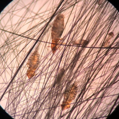 magnified-lice