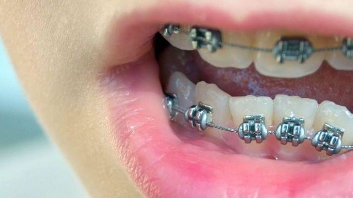 Crooked Teeth Straightening Braces