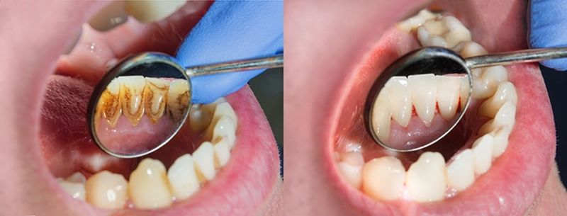 Periodontal Disease Stats