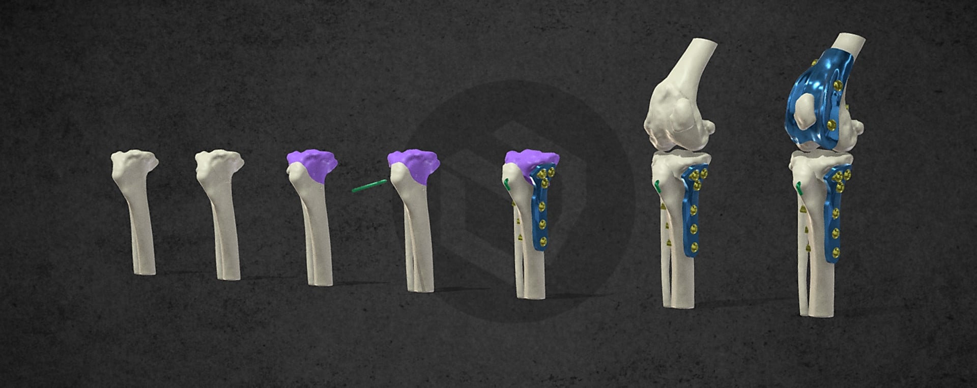 Simultaneous Use of Standard and 3D-Printed Implants? 