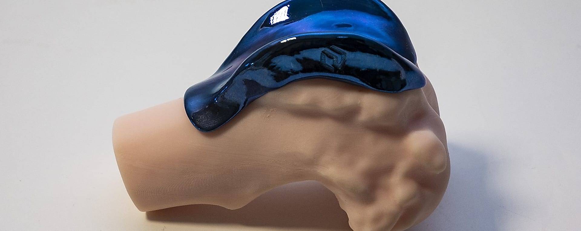 3D nyomtatott vs. hagyományos implantátumok