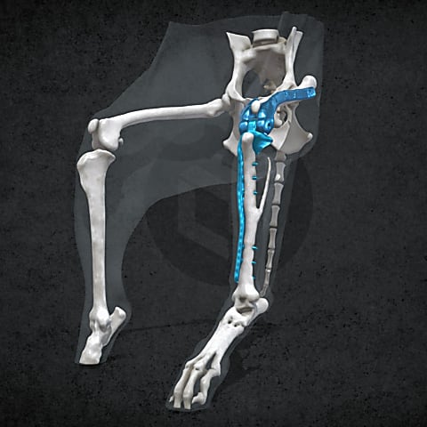 Total knee prosthesis