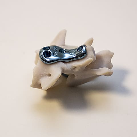 Atlantoaxial instability