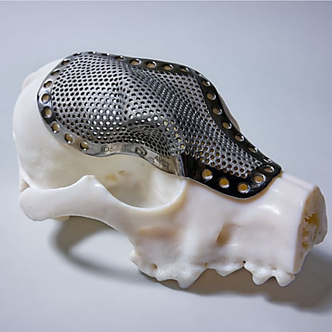 Skull implant