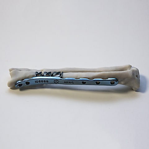 Sípcsonti implantátum