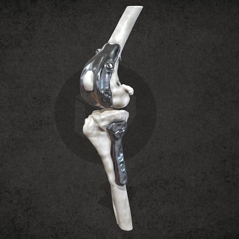 Patellar groove prosthesis