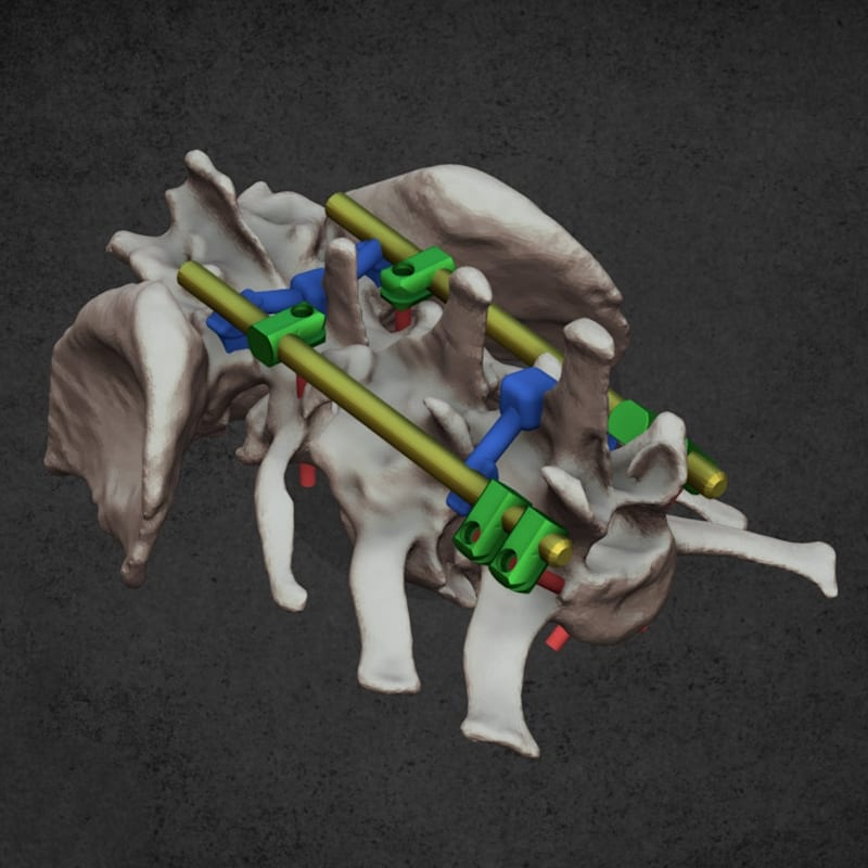 Drilling guides for spine surgery