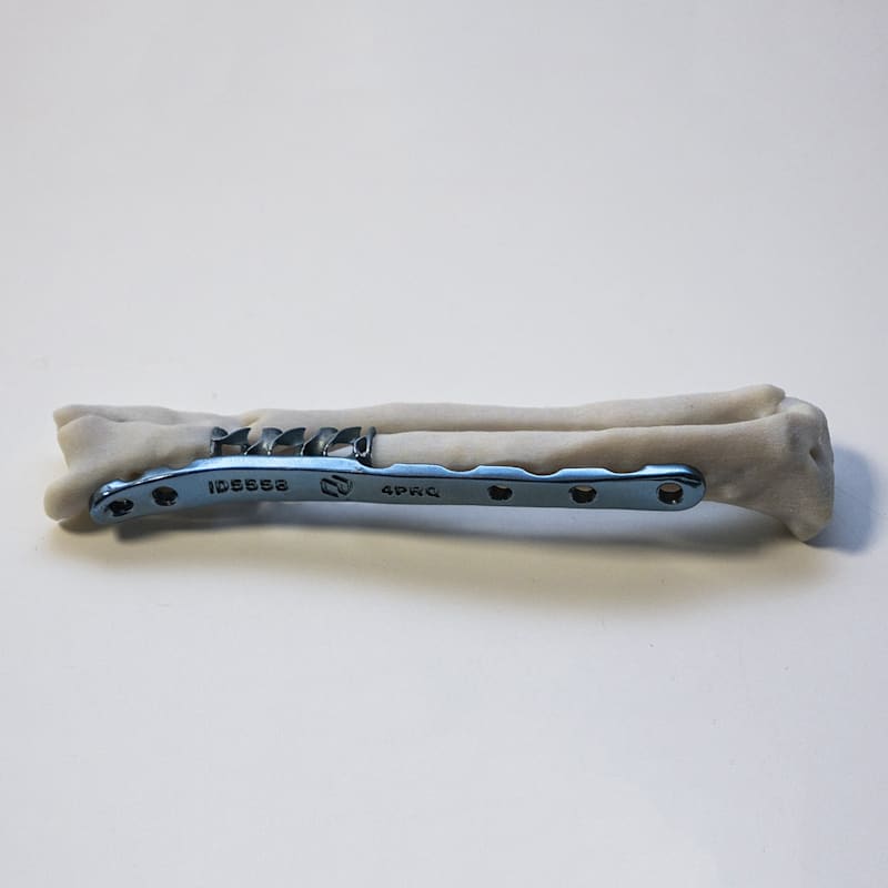 Sípcsonti implantátum