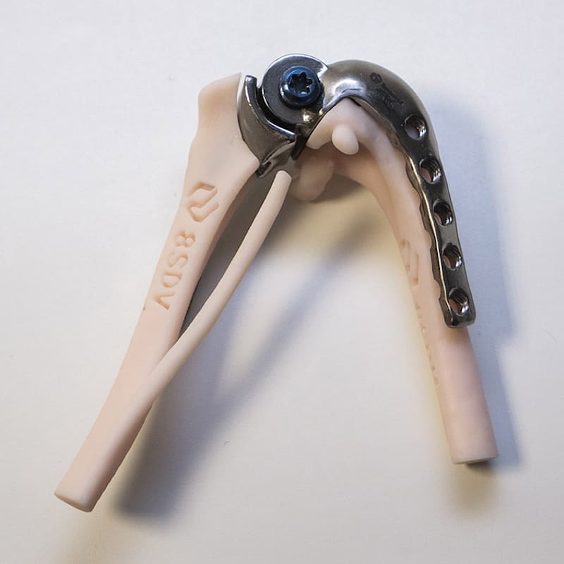 Total knee prosthesis