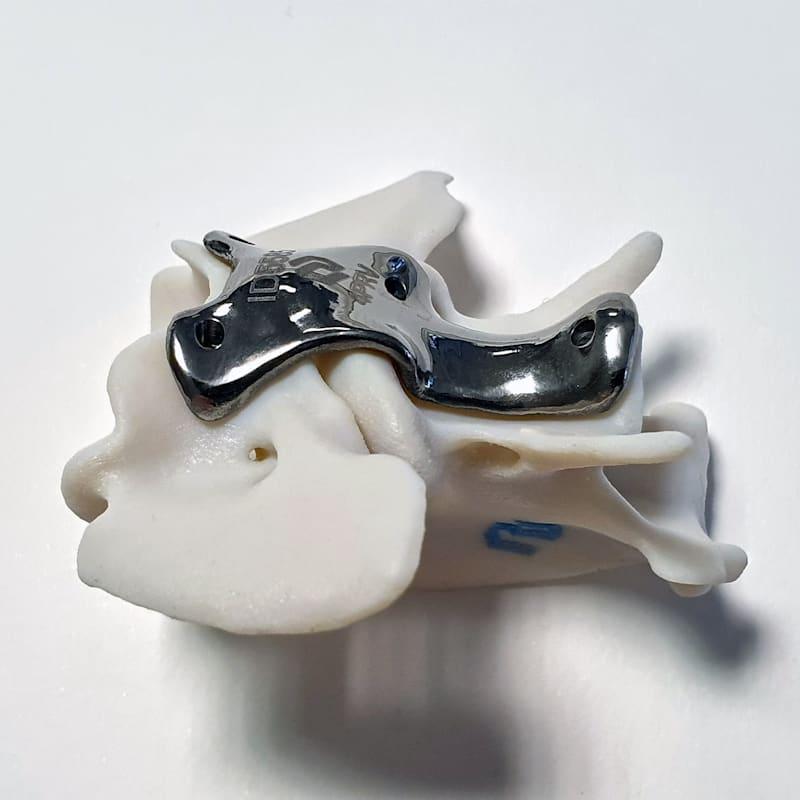 Atlantoaxial stabilization