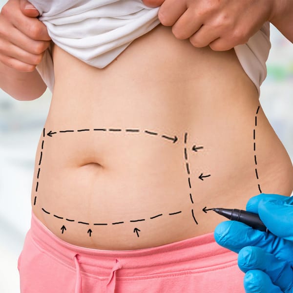 Tummy Tuck