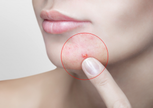 Acne Injection