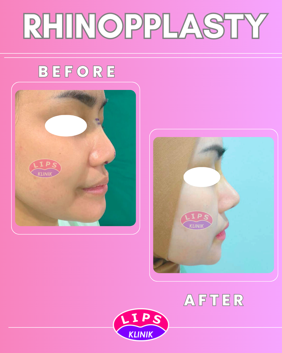 Rhinoplasty