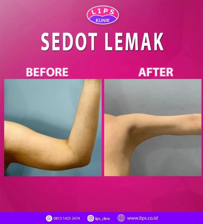 sedot lemak