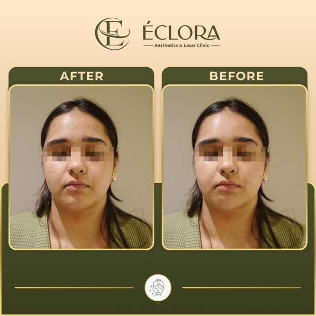 Acne & Acne Scars treatment result — before and after