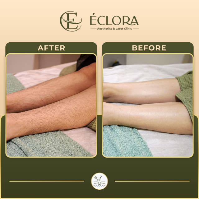 Laser Hair Reduction treatment result — before and after