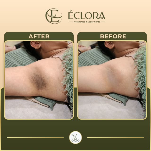 Underarm Hair Reduction treatment result — before and after