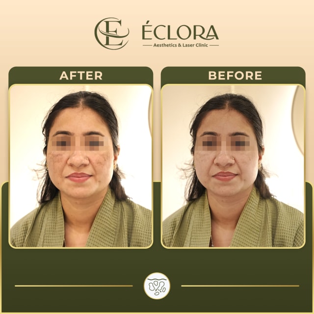 Pigmentation treatment result — before and after
