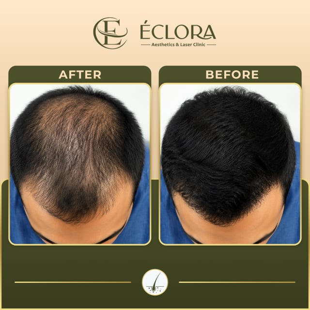 Hair Regrowth treatment result — before and after