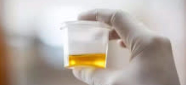 Urinalysis (UA)